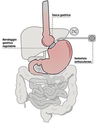 Bendaggio gastrico