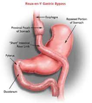 bypass gastrico
